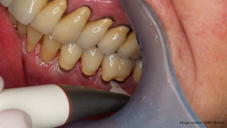 Image source: EMS Dental