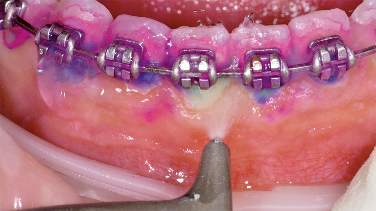 Airflow on orthodontics